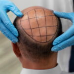 hair transplant cost in Pakistan